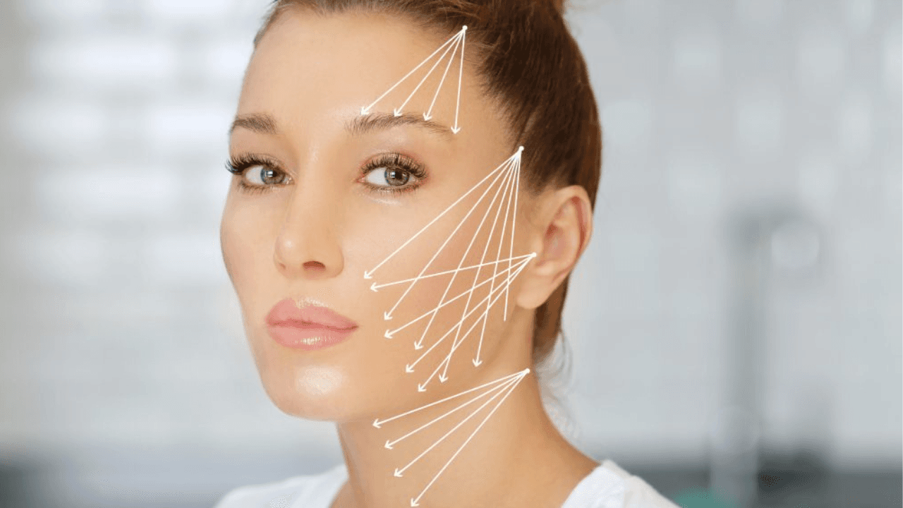 Threads Non-surgical Facelift - Treatment Results