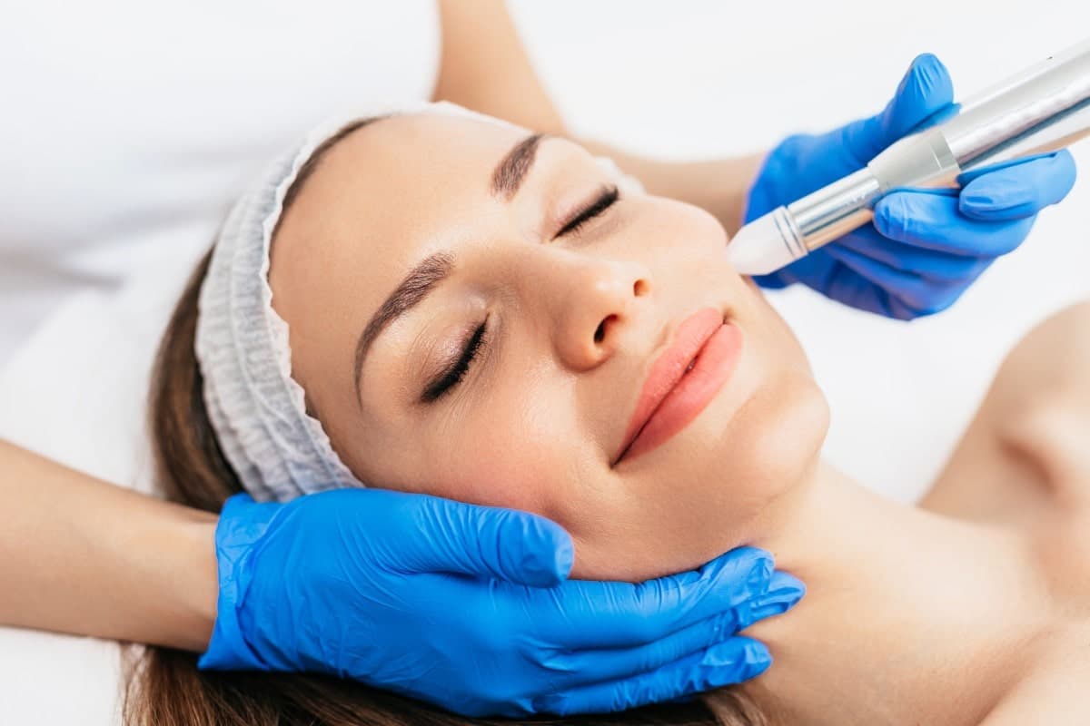 Microneedling treatment 2