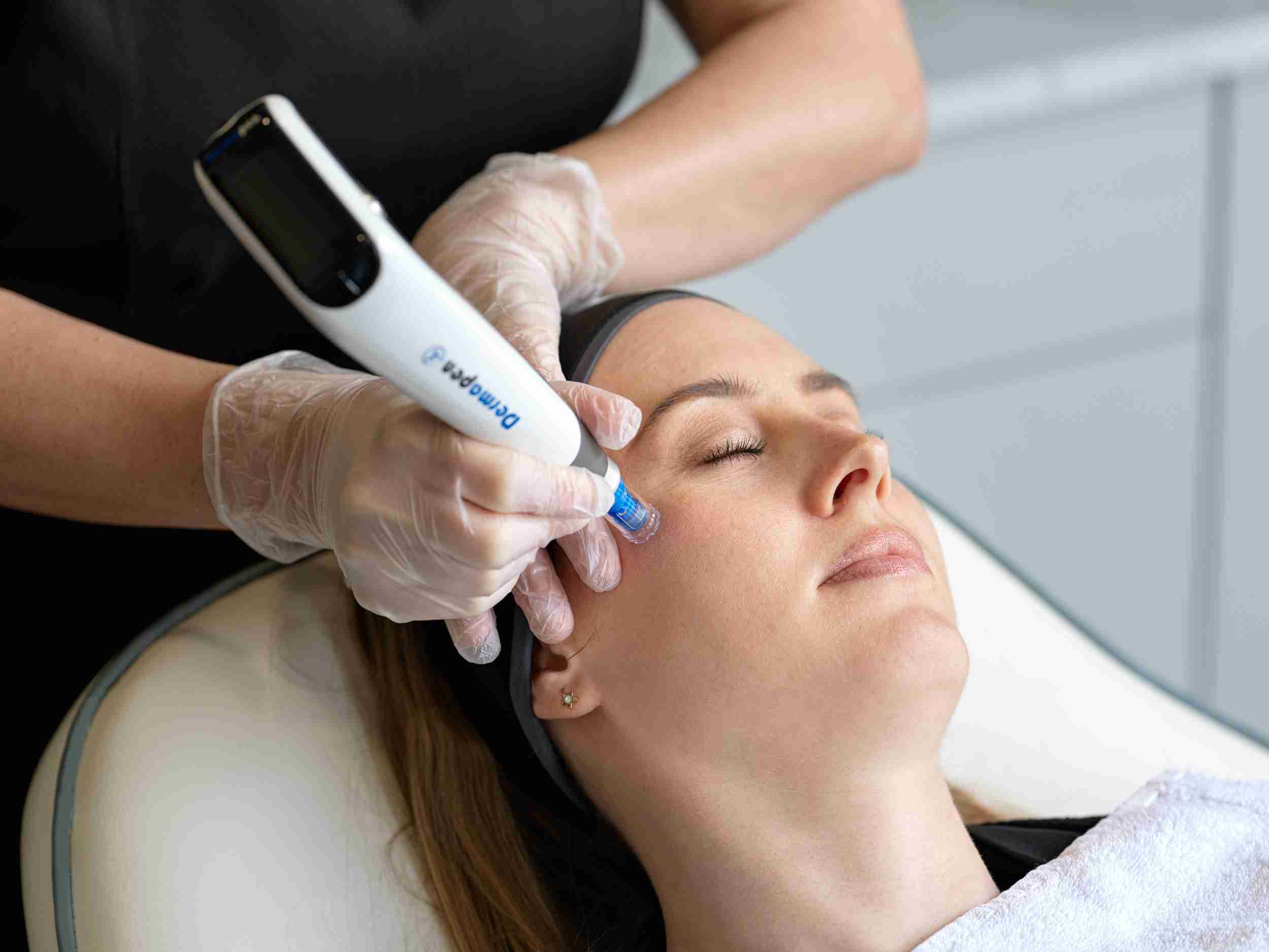 Microneedling