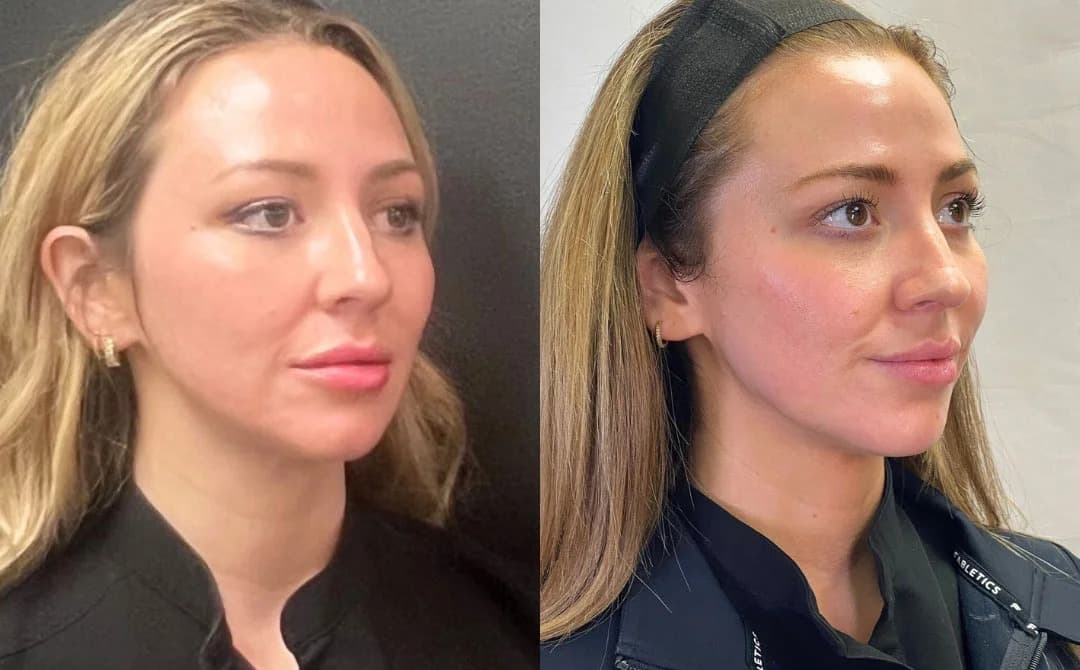 PDO Thread Lift - Client Results