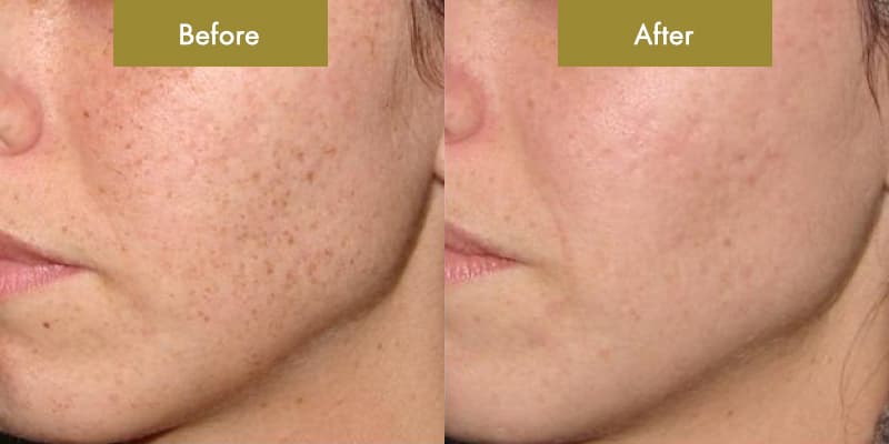 Threads Acne Scars treatment 2