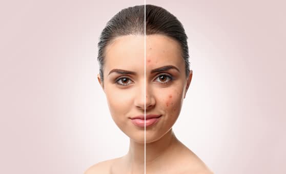 Threads Acne Scars treatment 3