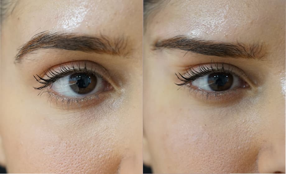 Under Eye Rejuvenation treatment 3