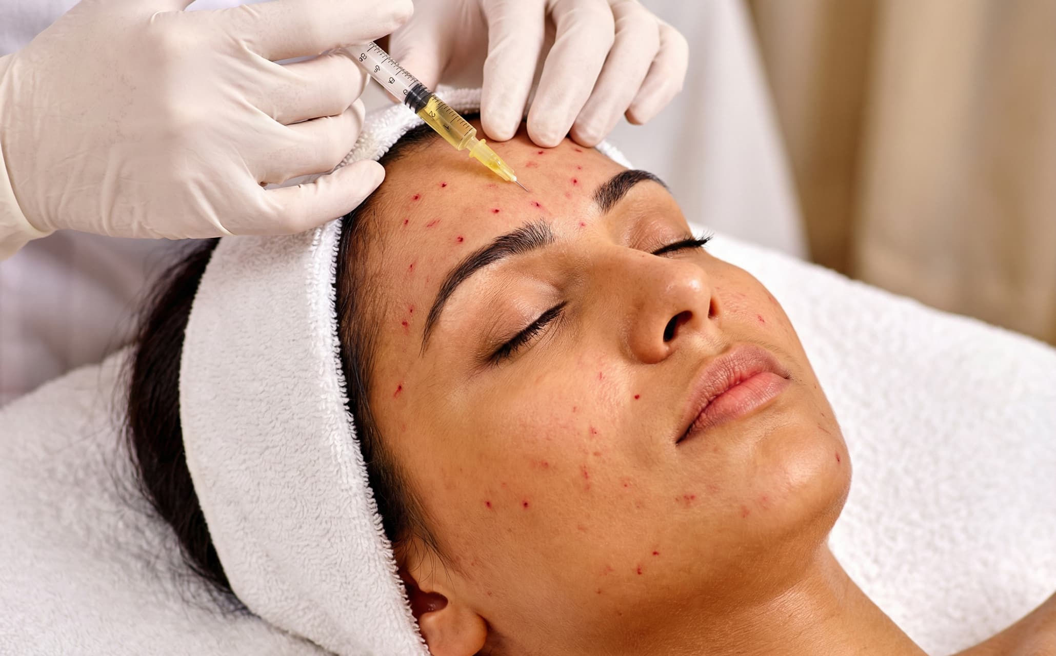 Vampire Facial treatment 1