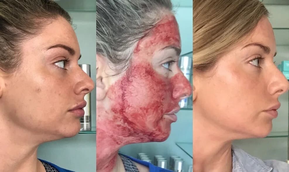 Vampire Facial treatment 2